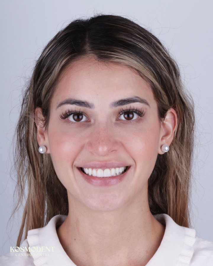 Antes de carillas de porcelana en Kosmodent, dentista en Cumbres, Monterrey (caso 1)