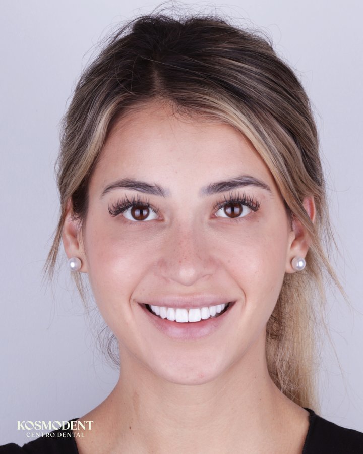 Después de carillas de porcelana en Kosmodent, dentista en Cumbres, Monterrey (caso 1)