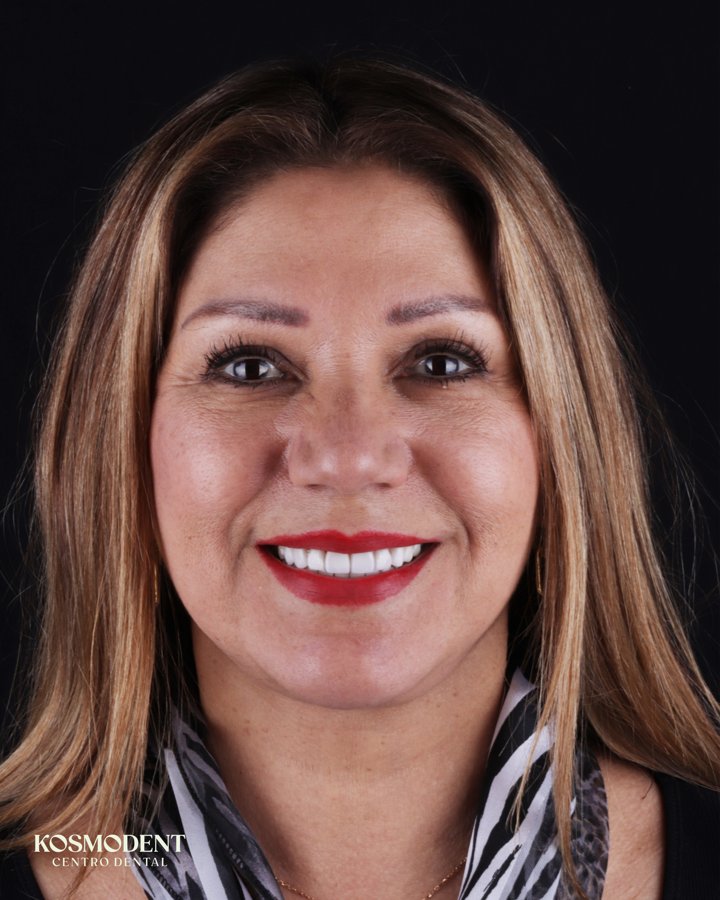 Después de carillas de porcelana en Kosmodent, dentista en Cumbres, Monterrey (caso 2)