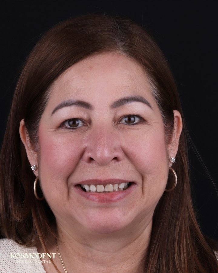 Antes de carillas de porcelana en Kosmodent, dentista en Cumbres, Monterrey (caso 3)