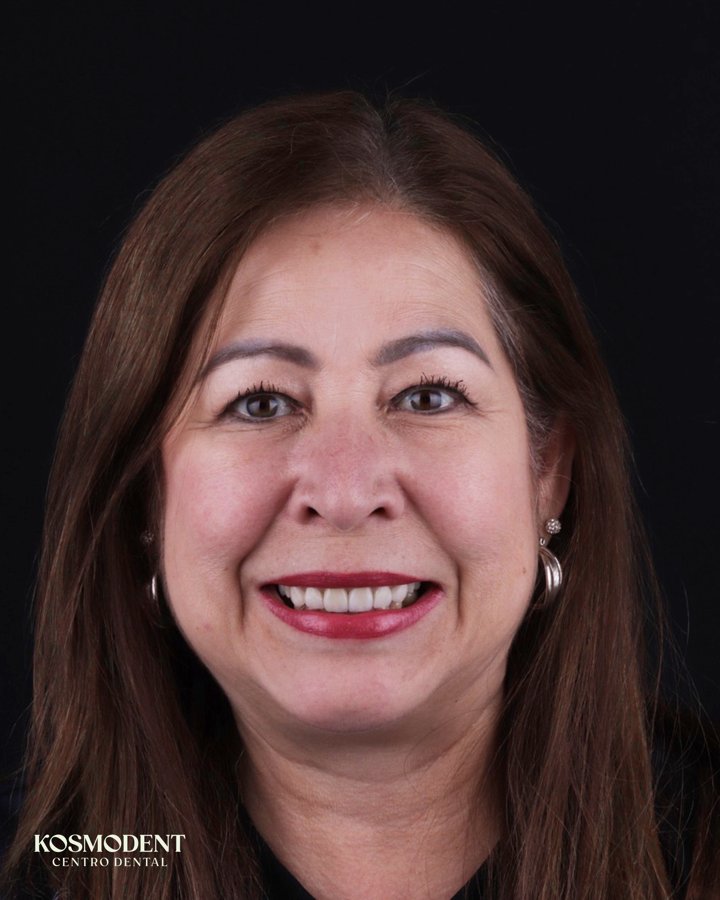Después de carillas de porcelana en Kosmodent, dentista en Cumbres, Monterrey (caso 3)