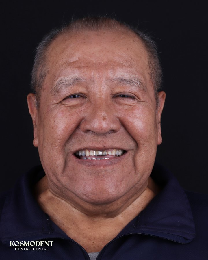 Antes de rehabilitación oral en Kosmodent, dentista en Cumbres, Monterrey